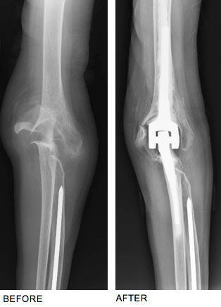 Dr. Steinberg Performs Total Elbow Joint Replacement to Successfully Treat Rheumatoid Arthritis Pain