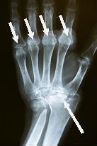 Rheumatologist Recommended Wrist Surgeon Dr. Steinberg Performs Hand and Wrist Reconstructive Surgery