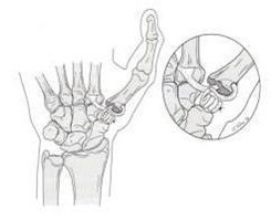 Orthopedic Doctor Steinberg Successfully Treats Thumb Arthritis with Joint Reconstruction