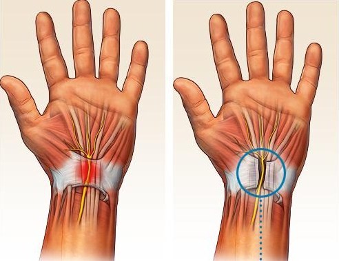 Dr. Steinberg Uses Endoscopic Carpal Tunnel Releases to Treat Hand Pain and Tingling in the Fingers