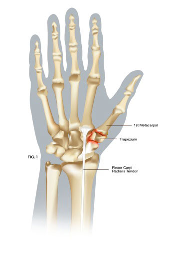 Thumb Arthritis