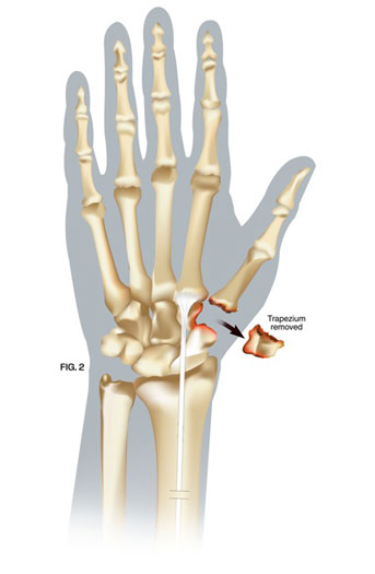 Thumb Arthritis