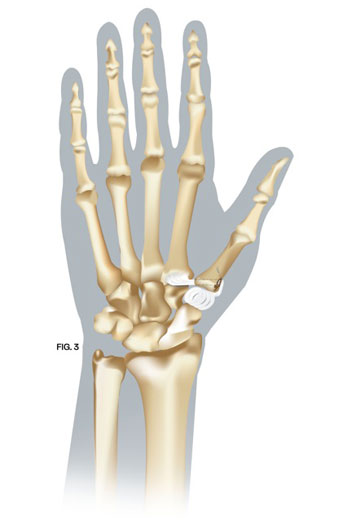 Thumb Arthritis